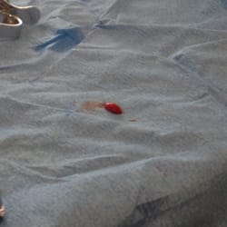 South Pasadena Oral Surgery - This is what they took out!  SO GROSS!! But, kinda cool in an odd way!!!
