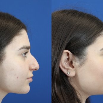 Eric Yavrouian, MD - 4 months post op - Ear Nose & Throat Near Me - Glendale, California