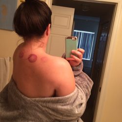Marino Acupuncture & Wellness Center - My markings