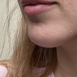 Facial Mania Med Spa - Midtown - Beautiful life filler and botox!! Extremely happy with my results!