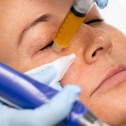 Vip Aesthetics By Vip Medical - PRP with Skinpen Microneedling!