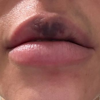 DermFx - Day after. - Medical Spas Near Me - Redondo Beach, California DermFx - Day after. - Medical Spas Near Me - Redondo Beach, California