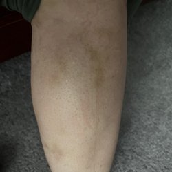 Women's Imaging Center - As of today my entire body is covered in bruises and I desperately needed the radiology they cancelled three times already.