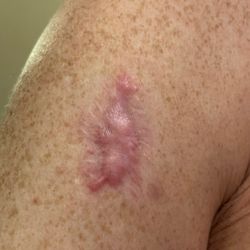 Advanced Dermatology - Scar