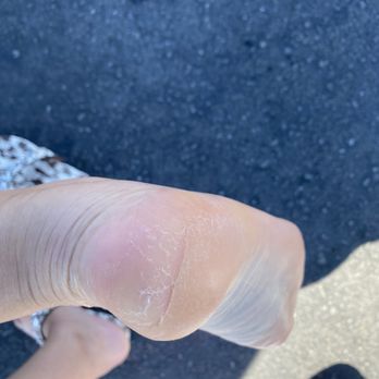Yvonne's Nails - After pedicure cracks still there - Nail Salons Near Me - Fremont, California Yvonne's Nails - After pedicure cracks still there - Nail Salons Near Me - Fremont, California