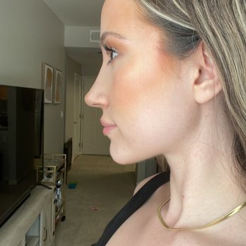 Dino Elyassnia, MD - One week post op (still swollen - day of cast removal) - Cosmetic Surgeons Near Me - San Francisco, California