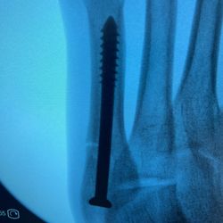 Eugene Curry, M.D. - Jones fracture screw in a football player