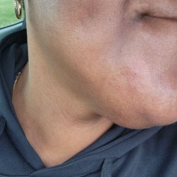 Follicle Free Electrology - Left chin - 3/2/2026 update