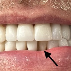 Royal Dental Care - Just one of many that fell off. VERY VERY BAD JOB