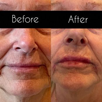 Project Glow - Lip and marionette line fillers - Medical Spas Near Me Project Glow - Lip and marionette line fillers - Medical Spas Near Me