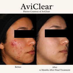 Spa Aesthetica Medical Spa & Wellness Center - AviClear: FDA-cleared laser for mild to severe acne. Targets sebaceous glands, drug-free with no downtime. Effective for all skin types.