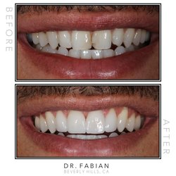 4 veneers were able to restore this young man's smile after years of chipped bonding and staining.