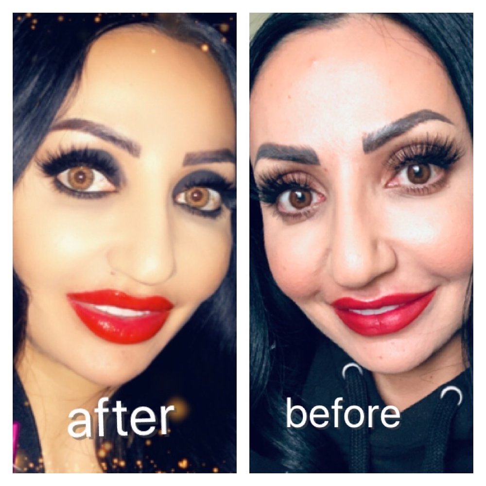Cloud 9 Medi Spa - My before and after of my nasal labial and lip injections by Kim - Medical Spas Near Me - Yucaipa, California Cloud 9 Medi Spa - My before and after of my nasal labial and lip injections by Kim - Medical Spas Near Me - Yucaipa, California