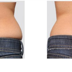 Body Contouring Treatment (love handles)