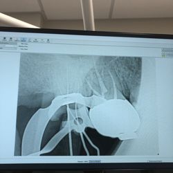 Torrance Endodontix - Dr. Saga's excellent handy work