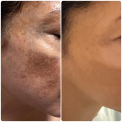 Jin's Intensive BDR microneedling facials can help clear melasma and hyperpigmentation for clearer, smoother, and tighter skin