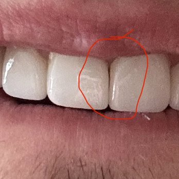 Luxe Dental Cosmetics - Gap between the teeth -- a visible gap remained between the front teeth after the veneers were installed - General Dentistry Near Me - Los Angeles, California Luxe Dental Cosmetics - Gap between the teeth -- a visible gap remained between the front teeth after the veneers were installed - General Dentistry Near Me - Los Angeles, California