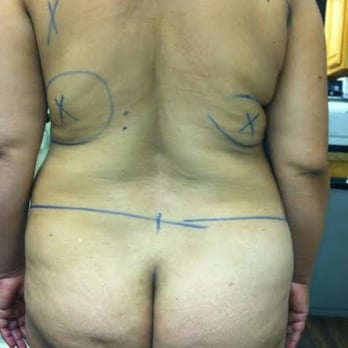 Ayman Shahine, MD - before - Cosmetic Surgeons Near Me Ayman Shahine, MD - before - Cosmetic Surgeons Near Me