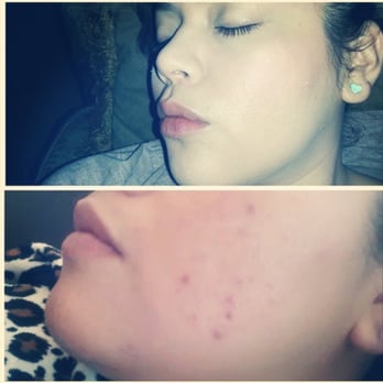 Celebrity Skin - My skin before and after ... Huge difference! - Medical Spas Near Me - Scottsdale, Arizona