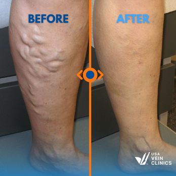 USA Vein Clinics - Vascular Medicine Near Me - Bellevue, Washington USA Vein Clinics - Vascular Medicine Near Me - Bellevue, Washington