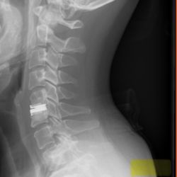 UCSF Spine Center - Happy new spinal cord - titanium! "Like Wolverine" my nephew exclaimed!