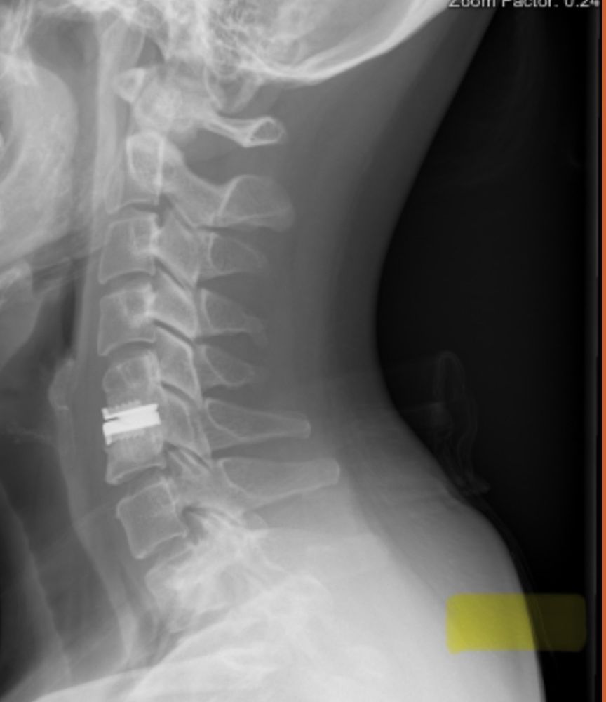 UCSF Spine Center - patient advocate in San Francisco, CA