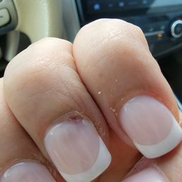 Hurt finger I have hole after she hurt it she did not touch it anymore so it's not evenly smooth Hurt finger I have hole after she hurt it she did not touch it anymore so it's not evenly smooth