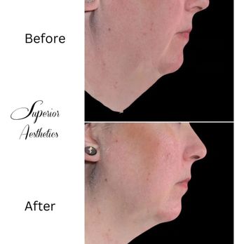 Superior Aesthetics - Jawline Sculpting in Marquette - Medical Spas Near Me - Marquette, Michigan Superior Aesthetics - Jawline Sculpting in Marquette - Medical Spas Near Me - Marquette, Michigan