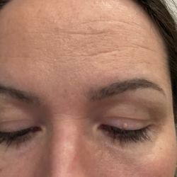 Total Skin Dermatology & Aesthetics - Fargo - BEFORE WITH TWO SKIN TAGS! So embarrassing