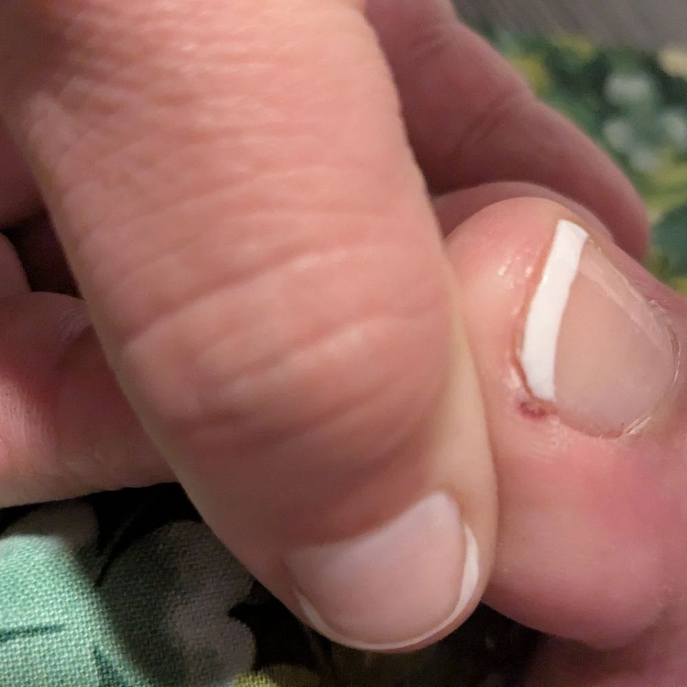 Got nipped,it hurts bad especially when there's pressure. Got nipped,it hurts bad especially when there's pressure.