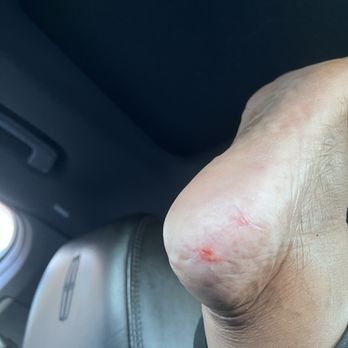 Luxury Spa Nails - My skin abrasion after a pedicure - Nail Salons Near Me - Bowie, Maryland