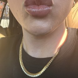BA Med Spa and Weight Loss Center - Lip filler next day!