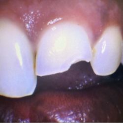 Hilltop Family Dental - My poor tooth :(