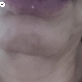 Personique Plastic Surgery Center - This are the results of my chin augmentation. On my side there is just so sad! - Cosmetic Surgeons Near Me - Austin, Texas Personique Plastic Surgery Center - This are the results of my chin augmentation. On my side there is just so sad! - Cosmetic Surgeons Near Me - Austin, Texas