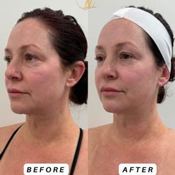Beauty Goals LV - Xerf before and after