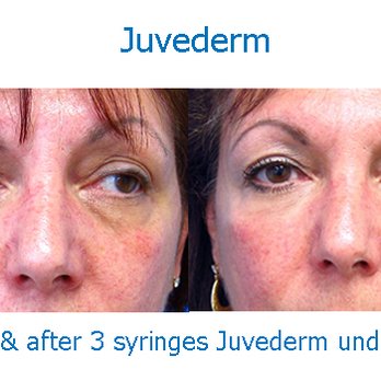 Skinspirations - Our patient before & after filler under eyes - Tattoo Removal Near Me - Clearwater, Florida Skinspirations - Our patient before & after filler under eyes - Tattoo Removal Near Me - Clearwater, Florida