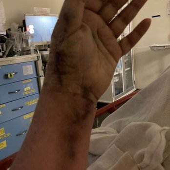 Damore Edward , MD - Four day after surgery the emergence doctor decided to replace the cast due to poor circulation. - Orthopedists Near Me - San Jose, California Damore Edward , MD - Four day after surgery the emergence doctor decided to replace the cast due to poor circulation. - Orthopedists Near Me - San Jose, California