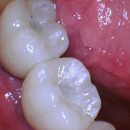 Tooth implants Tooth implants