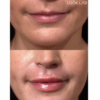 Look Lab Med Spa - Best Injector in Phoenix, AZ. - IV Hydration Near Me - Phoenix, Arizona