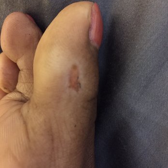 T Nails - Injury at T Nails in Bloomington MN - Nail Salons Near Me - Bloomington, Minnesota