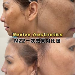 Revive Beauty Aesthetics - Before and after photo for M22 treatment