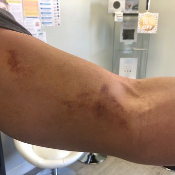 Cryocareusa - AFTER Hyperbaric Chamber.  Much improved. - Cryotherapy Near Me - Irvine, California