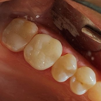 Los Angeles Dentists Group - Final Crown in place, upper left - Oral Surgeons Near Me - Glendale, California Los Angeles Dentists Group - Final Crown in place, upper left - Oral Surgeons Near Me - Glendale, California