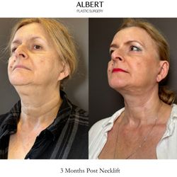 Mark G Albert, MD - 3 Months Post Necklift