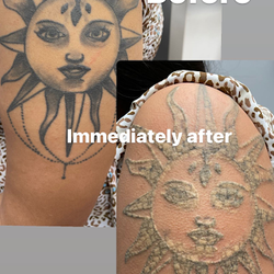 Dtown Laser Tattoo Removal & Aesthetics