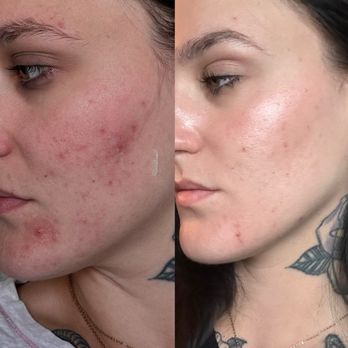 Balance Lab Aesthetics - My progress! I still have a bit of progress to go, but I couldn't be happier - Medical Spas Near Me - La Habra, California Balance Lab Aesthetics - My progress! I still have a bit of progress to go, but I couldn't be happier - Medical Spas Near Me - La Habra, California