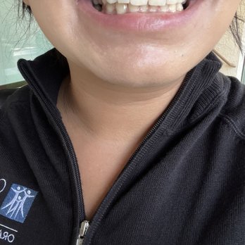 Rodney Ida, DDS - Immediately after 2nd session Internal bleaching. Tooth #8 - Endodontists Near Me - Tustin, California Rodney Ida, DDS - Immediately after 2nd session Internal bleaching. Tooth #8 - Endodontists Near Me - Tustin, California