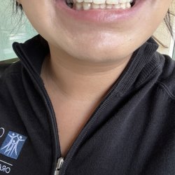 Rodney Ida, DDS - Immediately after 2nd session Internal bleaching. Tooth #8