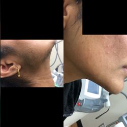 Diamond Laser Center Med Spa - Laser hair removal picture before/ after four treatments six treatments required for better results