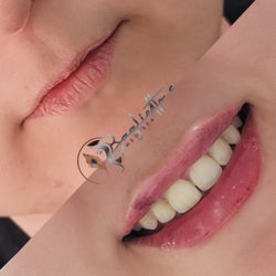 Baglietto's MedSpa - Lipfillers
